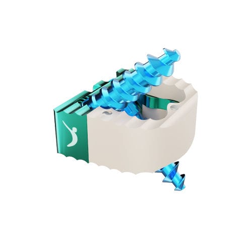 Gabbia intersomatica cervicale - PRORAY™  - Prodorth Spine - via anteriore / in PEEK