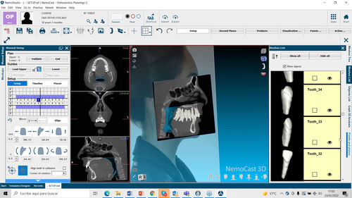 Software di pianificazione preoperatoria - NemoFab Ortho - Nemotec - medico / clinico / odontoiatrico