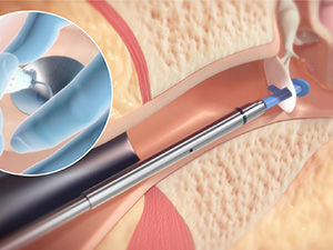 Aeratore transtimpanico - HUMMINGBIRD&reg; TTS - Preceptis Medical