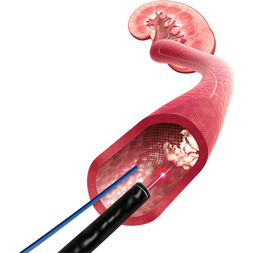Stent arteria renale - X-Filter™ - ROCAMED - in nitinol