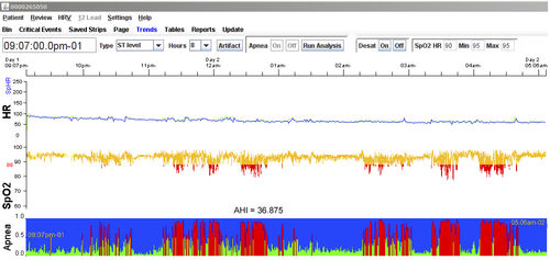 Software per polisonnografia - LX Sleep - NorthEast Monitoring - di prova / di registrazione / di analisi