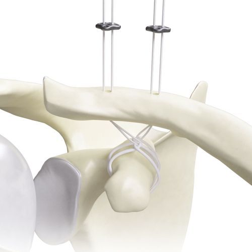 Bottone da sutura per ricostruzione del legamento acromio-clavicolare - Diamond - Canwell Medical