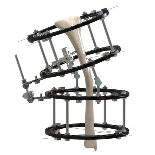 Fissatore esterno per tibia - 11611 series - Canwell Medical - ibrido / per adulti