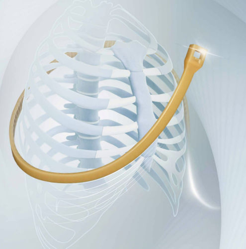 Filo per cerchiaggio ortopedico per chiusura dello sterno - SternoEaZip® - Kontour Medical Technology - monofilamento polimerico