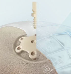 Impianto cranico su misura - CranioLink&trade; - Kontour Medical Technology
