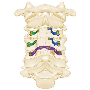Placca per laminoplastica per vertebra cervicale - Rita - Shanghai Sanyou Medical - per vertebra