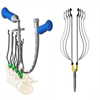 Sistema di posizionamento di viti peduncolari mininvasivo - Zina™ - Shanghai Sanyou Medical