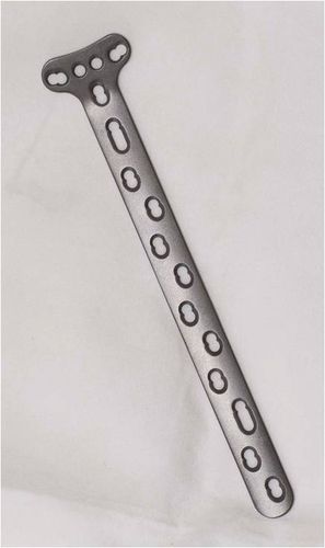 Placca di compressione per radio - 3.5T - Shanghai Sanyou Medical - distale / bloccata