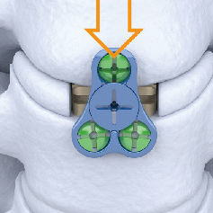 Gabbia intersomatica cervicale - Carmen® - Shanghai Sanyou Medical - via laterale