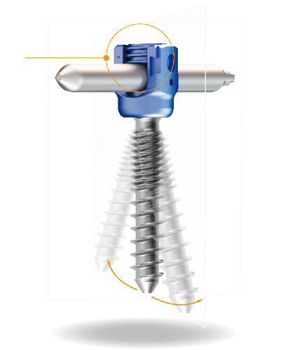 Vite peduncolare lombare - Lora™ MIS - Shanghai Sanyou Medical - toracica / canalare / in metallo