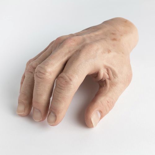 Protesi estetica mano - schubert and braun prothesenwerk - per adulti