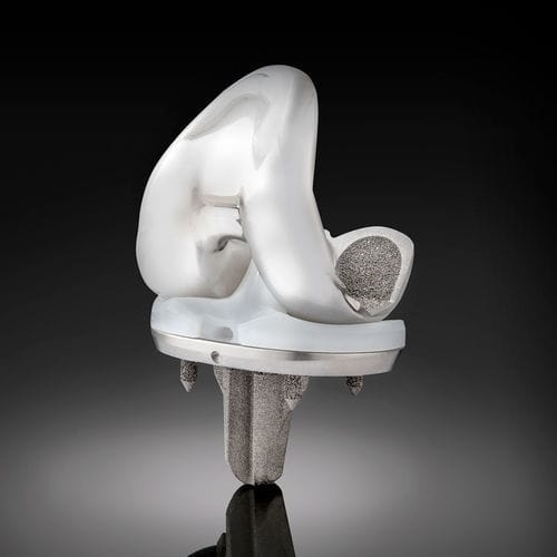 Protesi di ginocchio tricompartimentale - Truliant® Porous  - Exactech - a piatto mobile / non cementata
