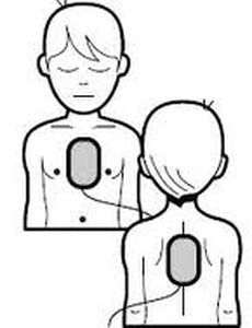 Elettrodo per defibrillazione pad - DART Sim ECG Simulator - pediatrico / di monitoraggio / di petto