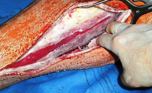 Simulatore didattico - Operative Experience Inc. - di fasciotomia / per chirurgia / di gamba
