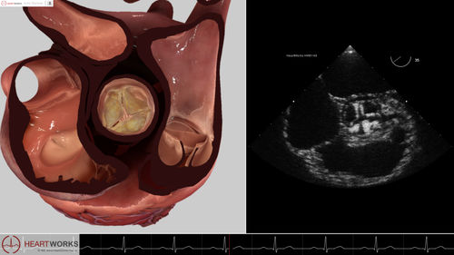 Modulo software per ecocardiografia - Pathology Module 2 - Inventive Medical Limited - di valutazione