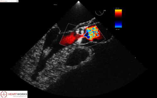 Modulo software per ecocardiografia - Pathology Module 4 - Inventive Medical Limited - di valutazione