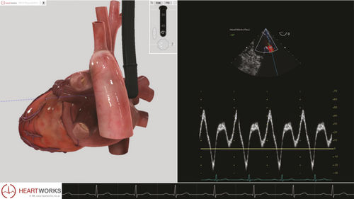 Modulo software per ecocardiografia - Pathology Module 3 - Inventive Medical Limited - di valutazione