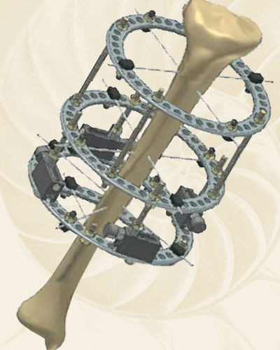 Fissatore esterno per femore - 952-352-80000  - Biotech Medical - circolare / per adulti