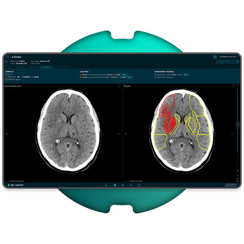Software per diagnosi di ictus - e-Stroke - Brainomix - medico / per tomografia computerizzata / di analisi delle immagini