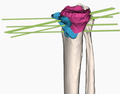 Dima di resezione per osteotomia tibiale - 3D Side