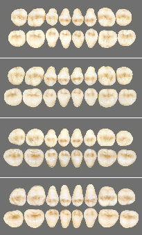 Protesi dentale in acrilico - Classic   - Wiedent - per denti posteriori