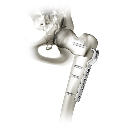 Placca di compressione per femore - 00-1200-2000 - OrthoPediatrics - prossimale / distale / bloccata
