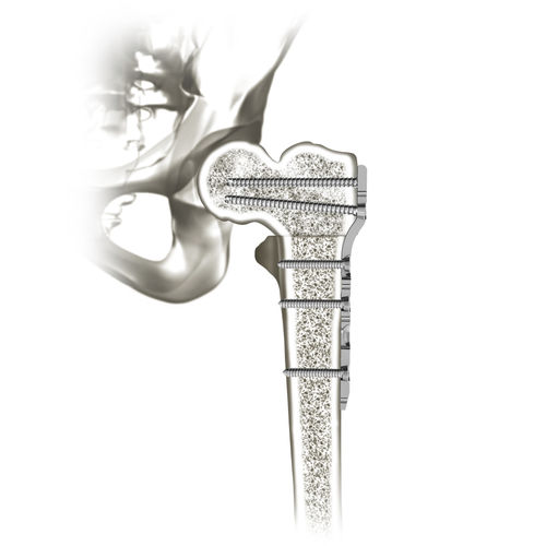 Placca di compressione per femore - 00-0907-0103 - OrthoPediatrics - prossimale / bloccata / in metallo