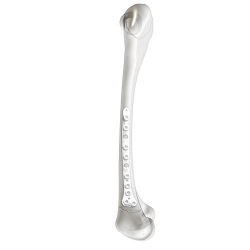 Placca di compressione per femore - PediLoc® - OrthoPediatrics - distale / laterale / bloccata
