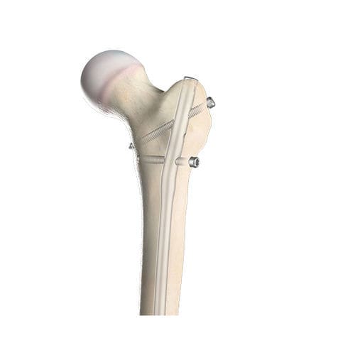 Chiodo intramidollare per femore - 00-1501-0720 - OrthoPediatrics - fissazione prossimale / fissazione distale / pediatrico