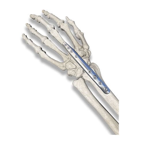 Placca per artrodesi per polso - PediFrag  - OrthoPediatrics - in metallo / pediatrica