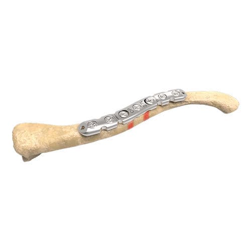 Placca di compressione per clavicola - 00-1005-5006 - OrthoPediatrics - mediale / bloccata / in metallo