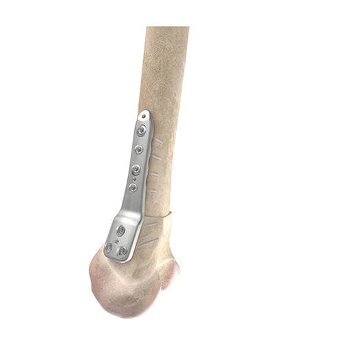 Placca per osteotomia per femore - 00-1050-5104 - OrthoPediatrics - distale / bloccata / in metallo