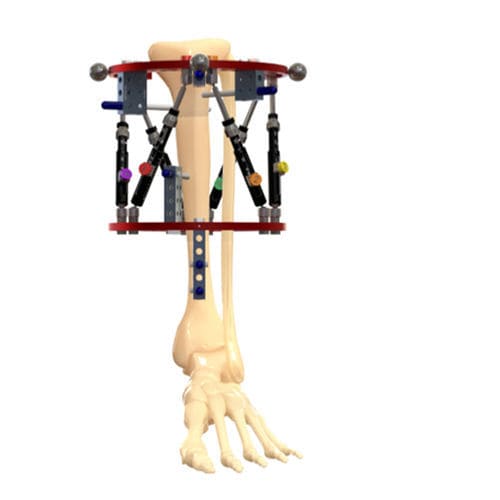 Fissatore esterno per tibia - ORTHEX - OrthoPediatrics - circolare / pediatrico