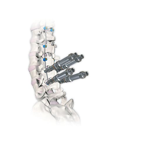 Sistema di osteosintesi toraco-lombare - RESPONSE™ 4.5/5.0 - OrthoPediatrics - via posteriore / pediatrico