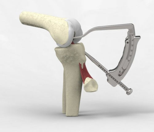 Strumentario chirurgico per ricostruzione del legamento crociato anteriore - NeoSys Medical Solutions