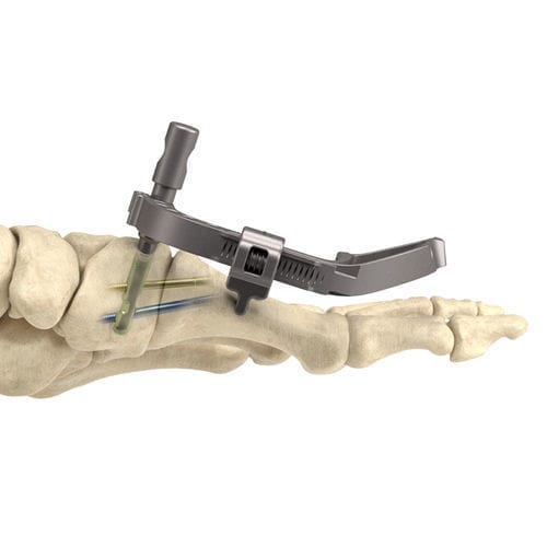 Vite per artrodesi per articolazione tarso-metatarsica - InCore® - Nextremity Solutions - senza testa
