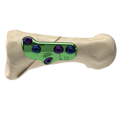 Placca per osteotomia per alluce valgo - Axi+Line® - Nextremity Solutions - per metatarso / prossimale / bloccata