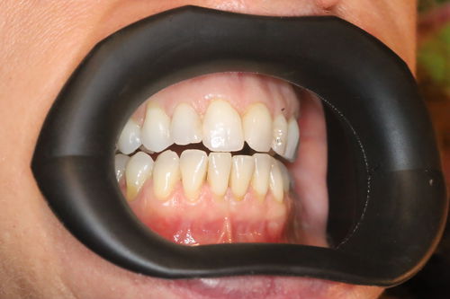 Divaricatore labiale - VisionButler™ - Gate Dental Services Ltd - guancia / odontoiatrico / autoclavabile