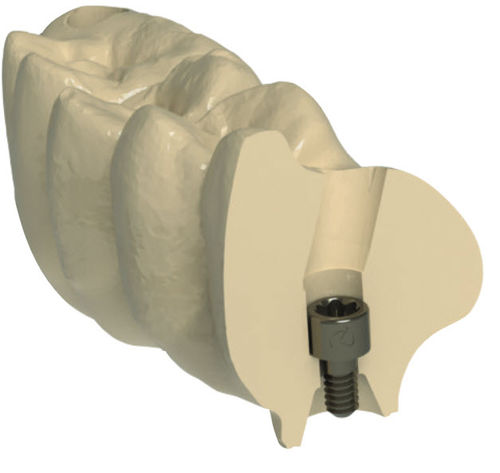 Materiale odontoiatrico per ricostruzione dentale - G-DAS - Dynamic Abutment Solutions - CAD CAM / di fresatura / ad alta traslucidità