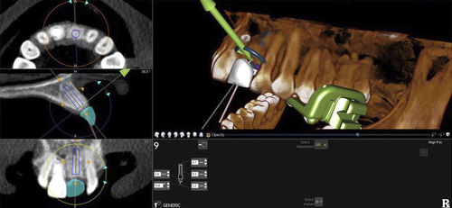 Software di pianificazione - X-Guide - X-Nav Technologies - d’importazione / di navigazione / di anatomia
