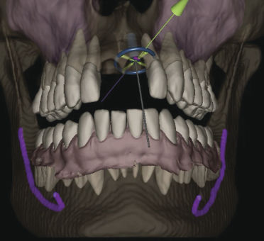 Software di anatomia - IconiX  - X-Nav Technologies - odontoiatrico / per chirurgia / di pianificazione
