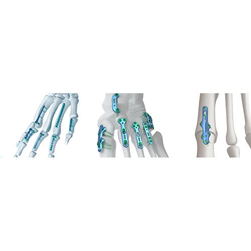 Placca di compressione per falange della mano - Irene Ortho - per articolazione tarso-metatarsica / bloccata / in metallo