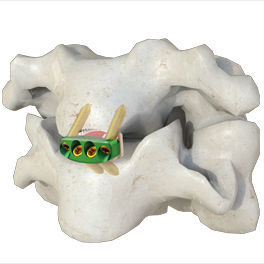 Gabbia intersomatica cervicale - 0-P - Irene Ortho - via anteriore / con placca ossea cervicale