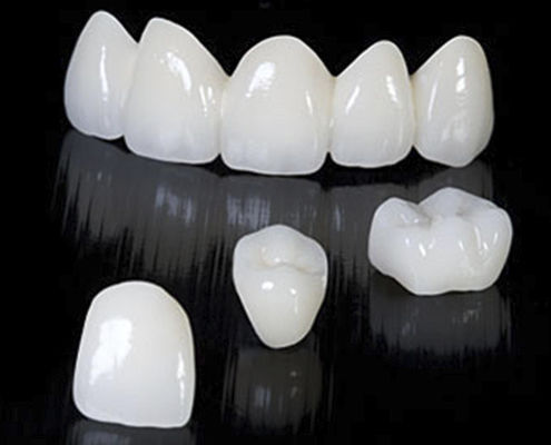 Ponte dentale in zircone - CRYSTAL - Derby Dental - per denti anteriori