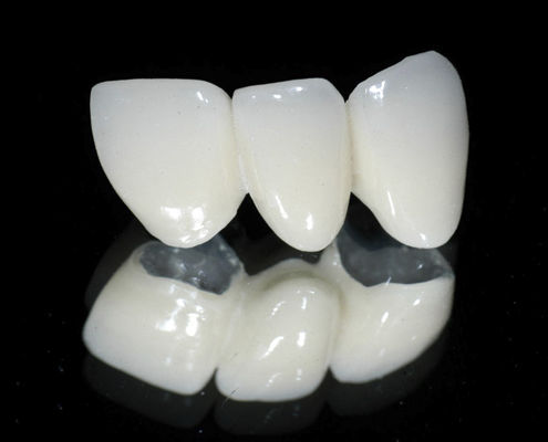 Ponte dentale in metallo-ceramica - CLASSIC  - Derby Dental - per denti anteriori / per denti posteriori
