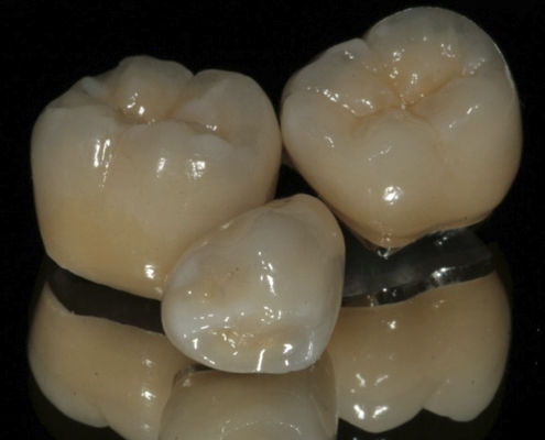 Corona dentale in metallo-ceramica - ECONOMY  - Derby Dental - per denti anteriori / per denti posteriori