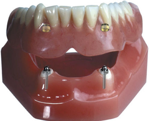 Protesi dentale per denti anteriori - Attachment Retained  - Derby Dental - per denti posteriori