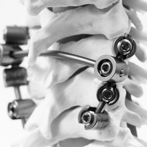 Sistema di osteosintesi cervicale - KM BEBE - NEURO FRANCE Implants - via posteriore / per adulti / pediatrico
