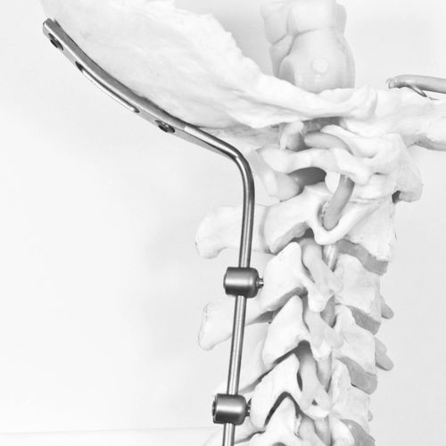 Sistema di osteosintesi occipitocervicale - J.O.C. - NEURO FRANCE Implants - via posteriore / per adulti