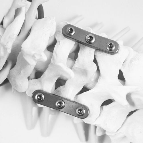 Placca per artrodesi per vertebra cervicale - STABILAR® PCP - NEURO FRANCE Implants - non bloccata / in titanio